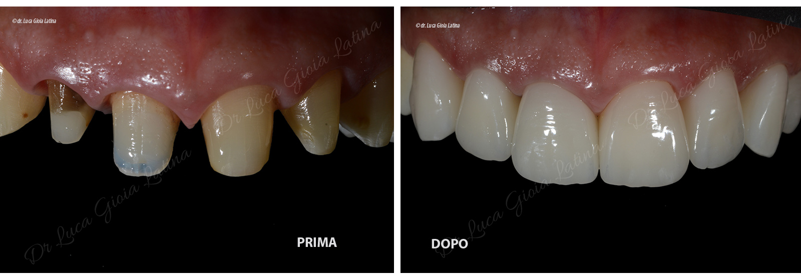 denti-zirconia-latina1 denti-zirconia-latina1